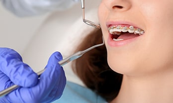 5 Signs that indicate you need Braces to align your teeth