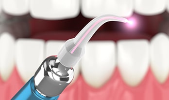 Advantages of Laser Dentistry