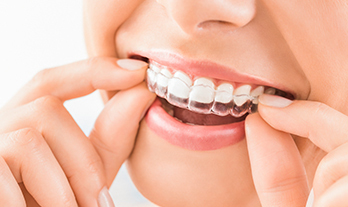 Invisalign Treatment – Rebuild Your Confidence