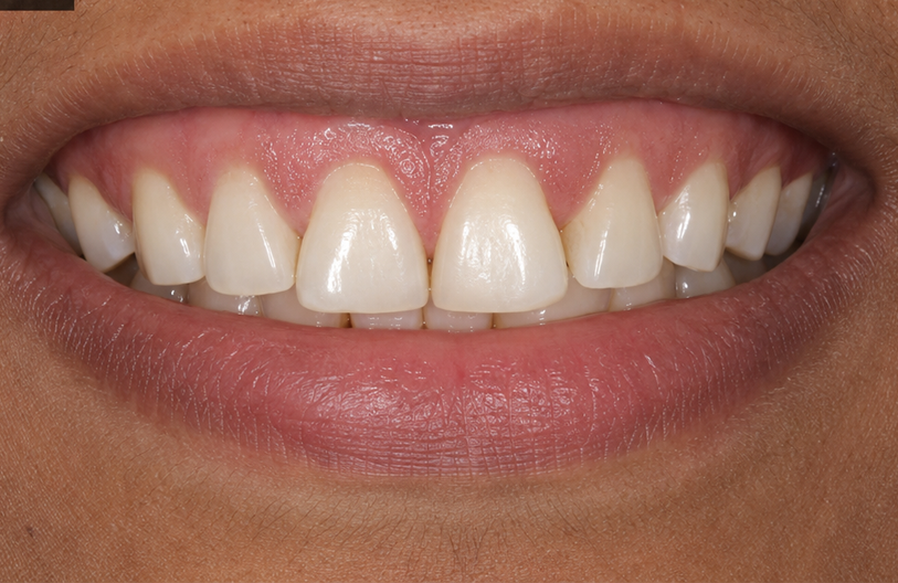 After Image