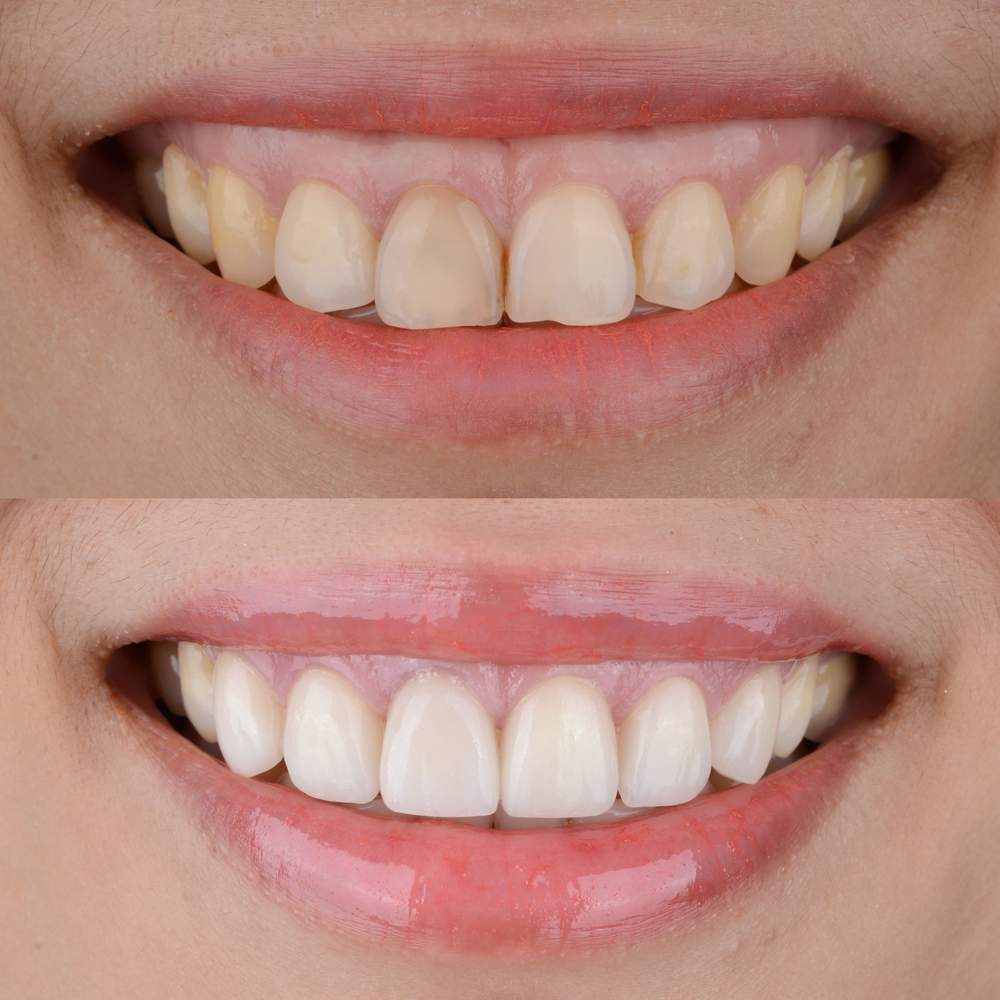 Gummy Smile Correction Radiant Dental