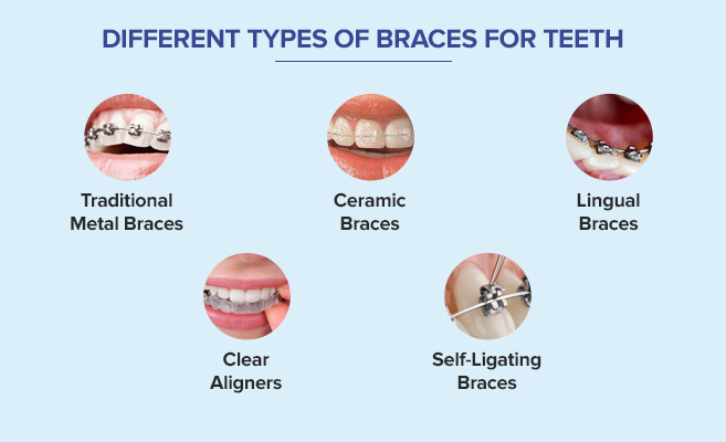 different types of braces for teeth