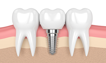 3 Types of Dental Implants and Which One is Best for You?