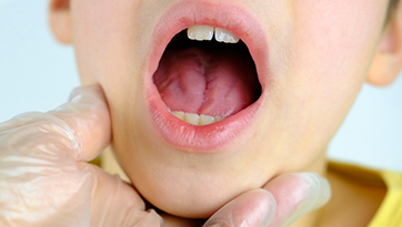 Healing the Tongue Frenulum: How Long Does It Take to Recover?