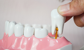 Soothing Advice: Tips to Manage Wisdom Teeth Removal