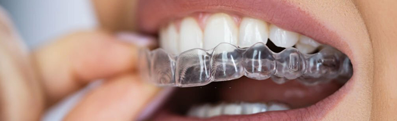 Clear aligners  Transparent Teeth Braces in Chennai
