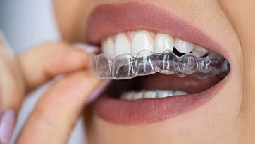 Braces or Invisalign – Comparison – What Works Better?