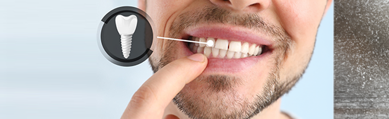 how dental implants can elevate your health and confidence