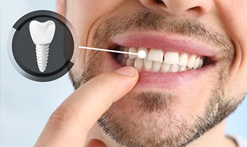 How Dental Implants Can Elevate Your Health and Confidence
