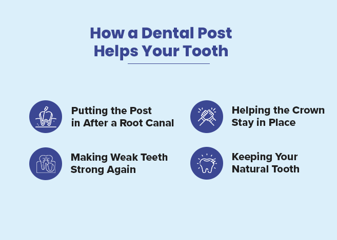 how dental posts can save your teeth info