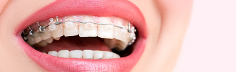 Self Ligating Braces Vs Traditional Braces - Know The Difference