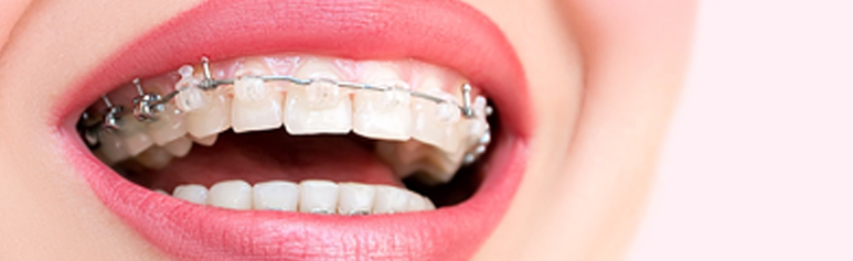 Self Ligating Braces vs Traditional Braces - Know the Difference