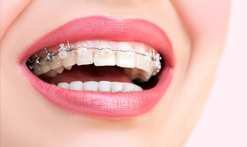 Self-Ligating Braces vs Traditional Braces – Know the Difference