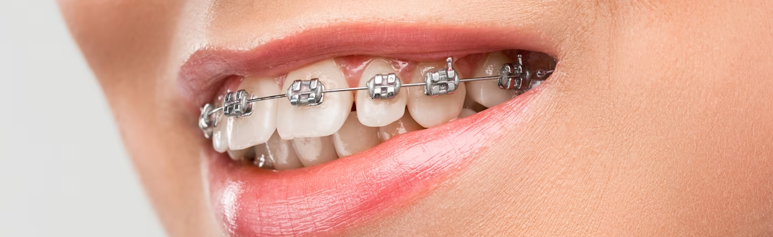 understanding the world of dental braces