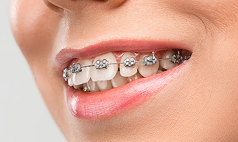 Understanding the World of Dental Braces: Your Path to a Perfect Smile