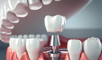 Dental Implant Treatment Options for Missing Teeth