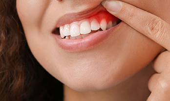 What is Gum Disease and How to Prevent Teeth Loss