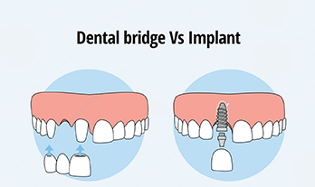 Dental Bridge vs Implant: Which Is the Right Choice?