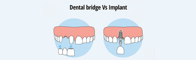 Dental Bridge vs Implant: Which Is the Right Choice