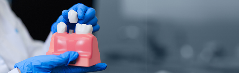 understanding the roles and benefits of dental crowns for stronger teeth