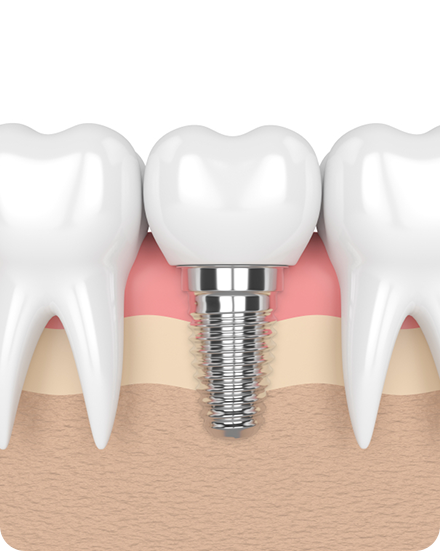 Dental Implants