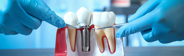 dental implants all on four single tooth full mouth