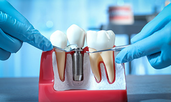 Dental Implants: All on Four, Single Tooth, Full Mouth