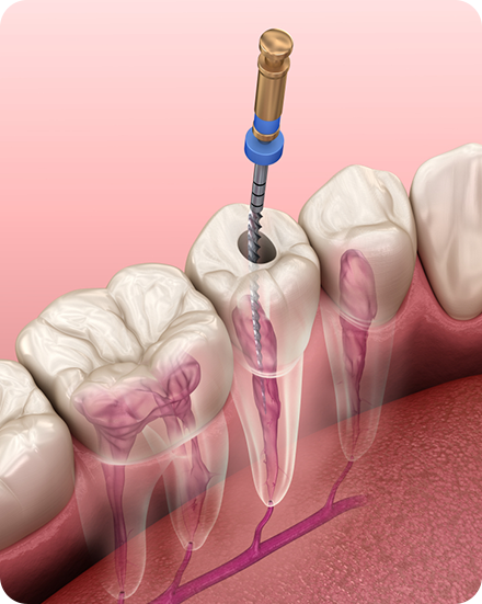 Root Canal Treatment