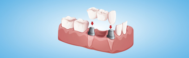 what is the cost of bone grafting for dental implants