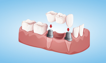 What is the cost of Bone Grafting for Dental Implants?