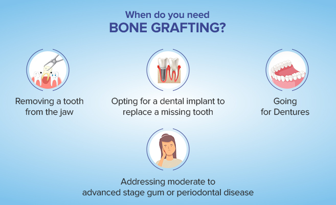 when do you need bone grafting