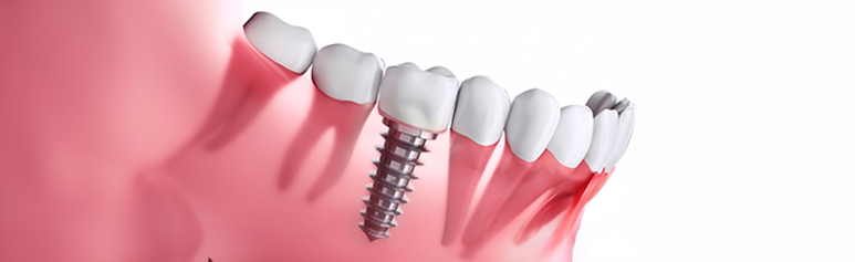 choosing best dental implants in chennai