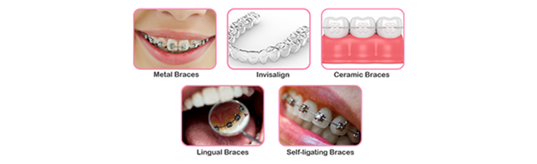 different types of braces are available which is best for you (2)