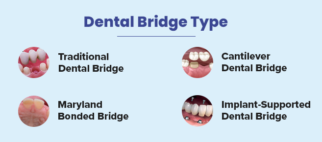 dental bridge type