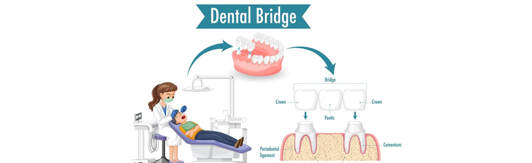 when do we need dental bridge treatment