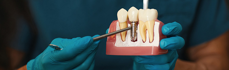 tooth implants cost in chennai