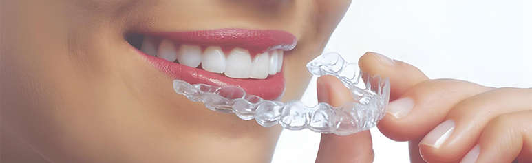 Invisalign Cost in Chennai