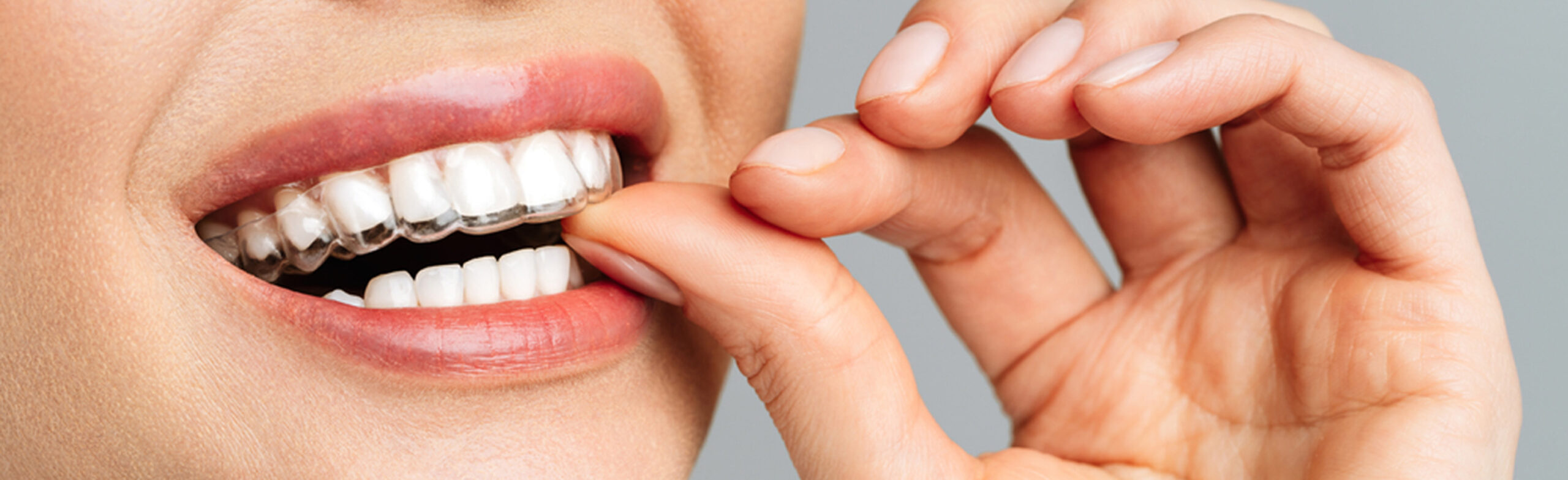 Invisalign Treatment in Adyar