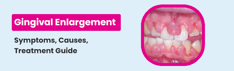 gingival enlargement