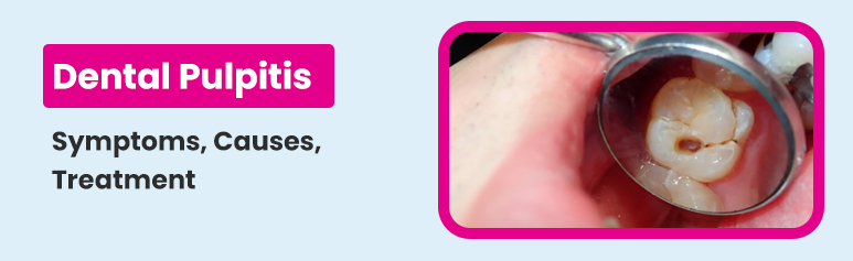 dental pulpitis treatment