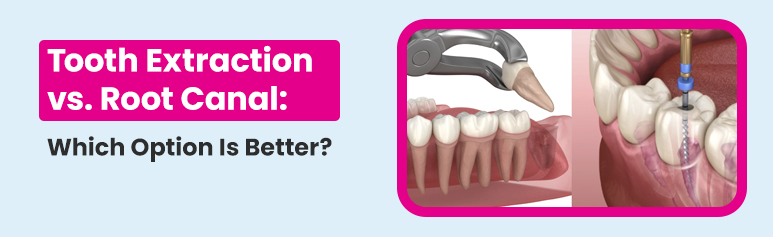 tooth extraction vs root canal