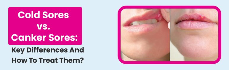 cold sores vs canker sores