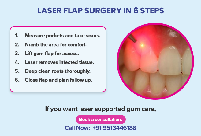 laser flap surgery in 6 steps