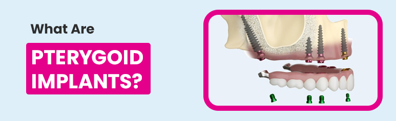 what are pterygoid implants