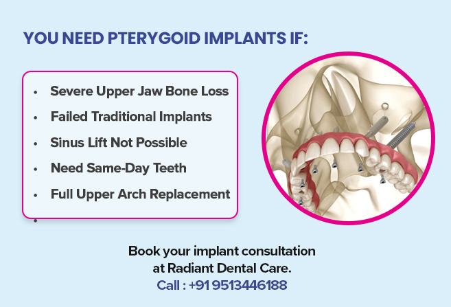 you need pterygoid implants if