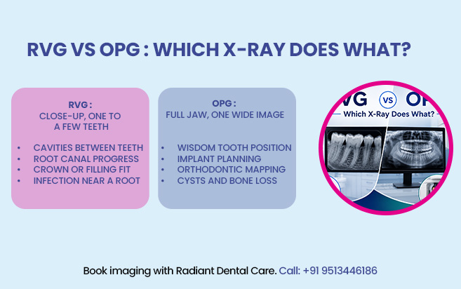 RVG vs OPG - which x-ray does what