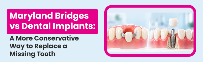 maryland bridges vs dental implants